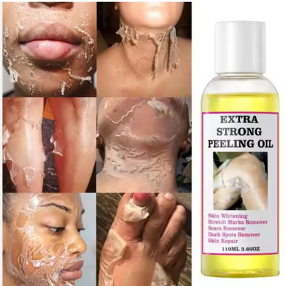Huile de Peeling Extra forte :  Vergeture, éclaircissante, hydratante