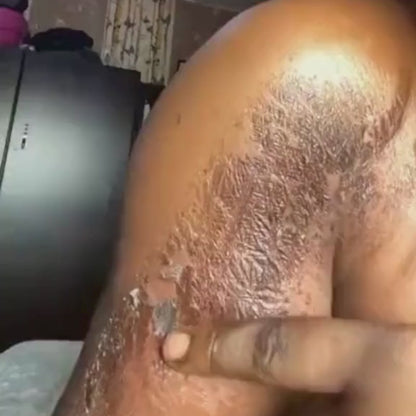 Huile de Peeling Extra forte :  Vergeture, éclaircissante, hydratante